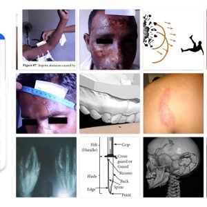 Illustrated Forensic Medicine Atlas Part 1 (A Compilation of Injuries and Their Medico Legal Analysis)